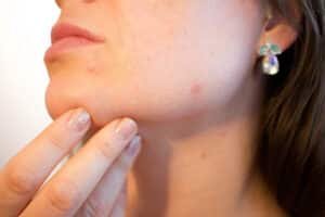 Skin treatment