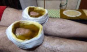 Janu Vasthi Treatment in Ayurveda