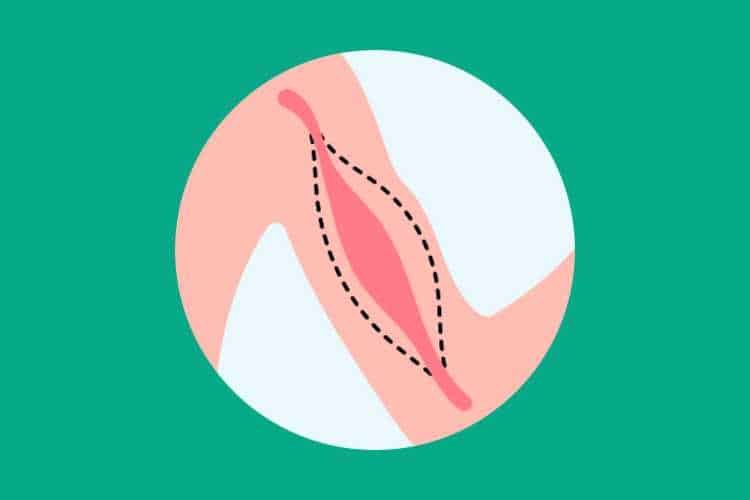 Muscular Dystrophy
