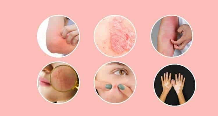 Ayurvedic Treatment for skin diseases in Kerala